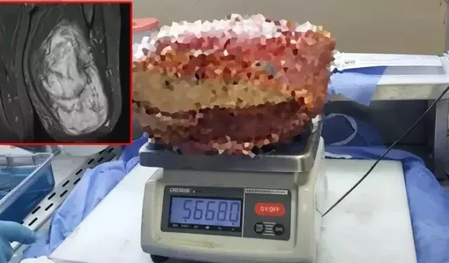Hastanın bacağında çıkan şey şoke etti: Tam 5 kilo 668 gram!